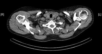 Case Report: Familial Hypocalciuric Hypercalcaemia and Hashimoto's Thyroiditis